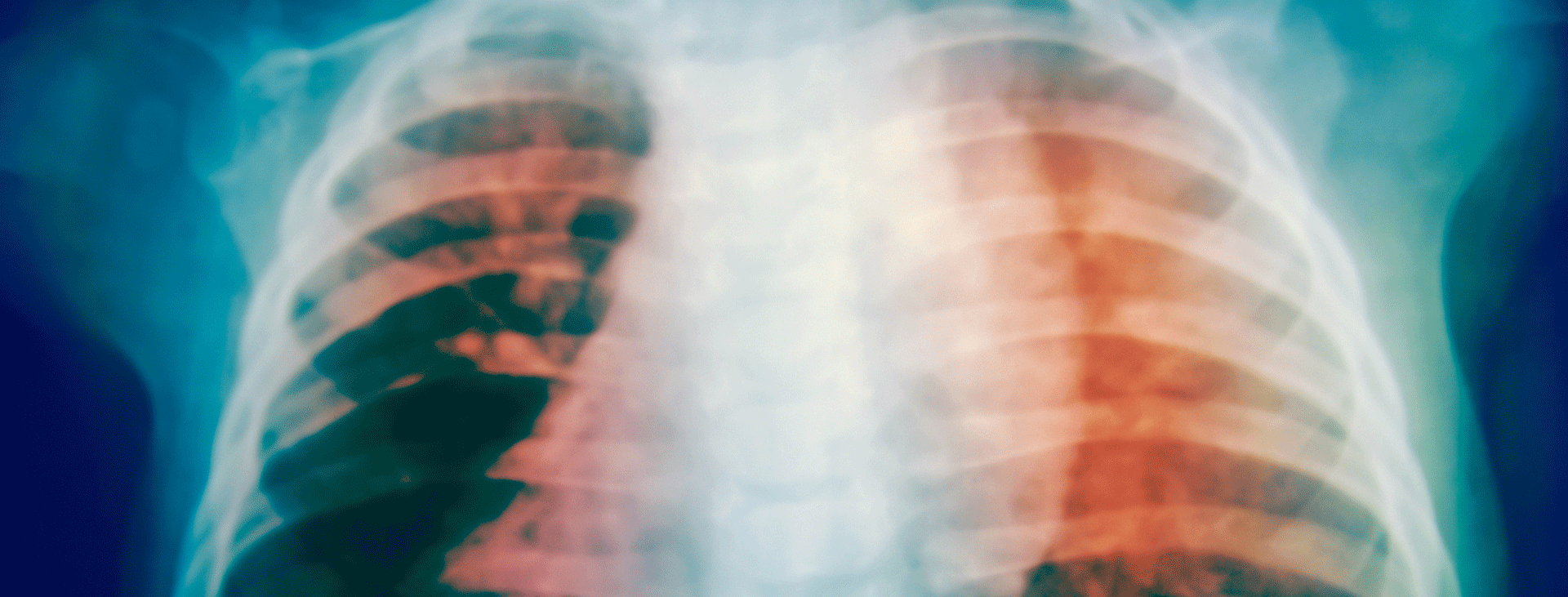 Chest xray